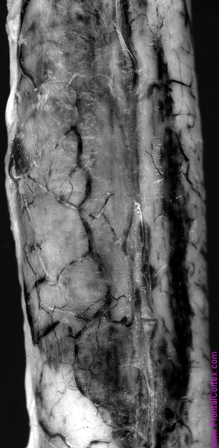 Intramedullary hemorrhage in a patient with vasculitis